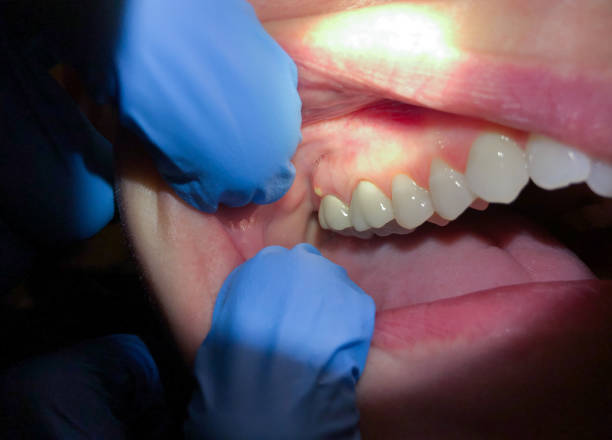 Best Emergency Treatment for Toothache in Fruitland, NC